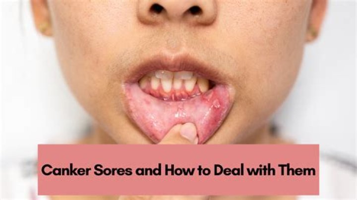 How do you get rid of cankers