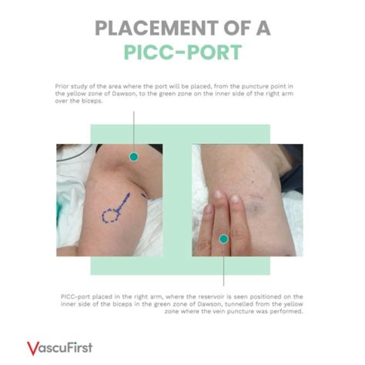 Which is better PICC line or port